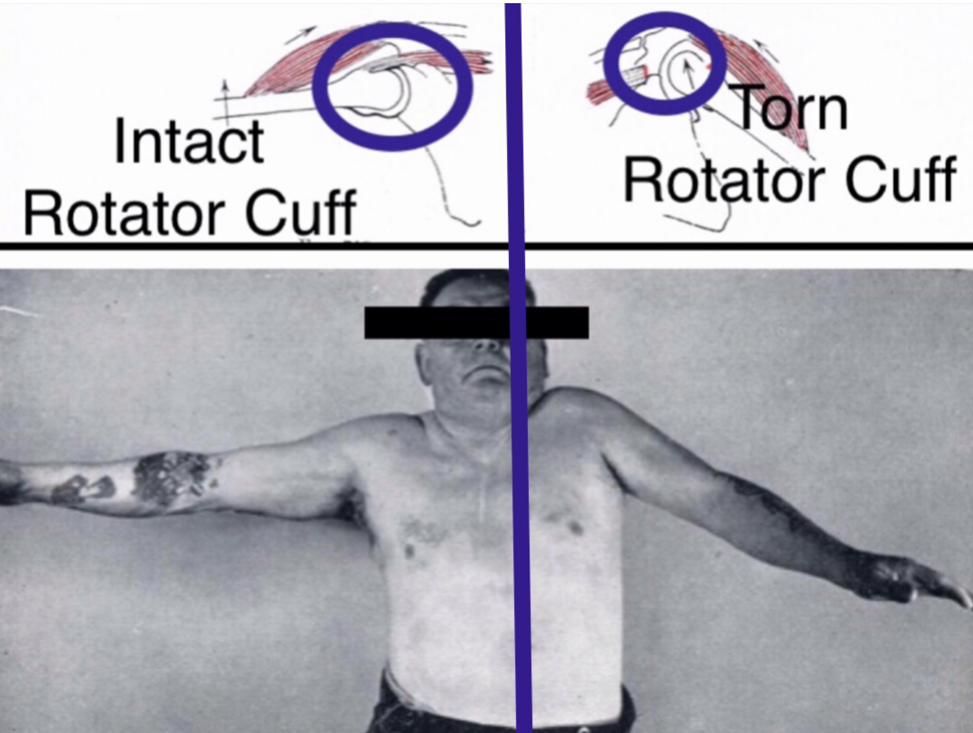 rotator tear symptoms