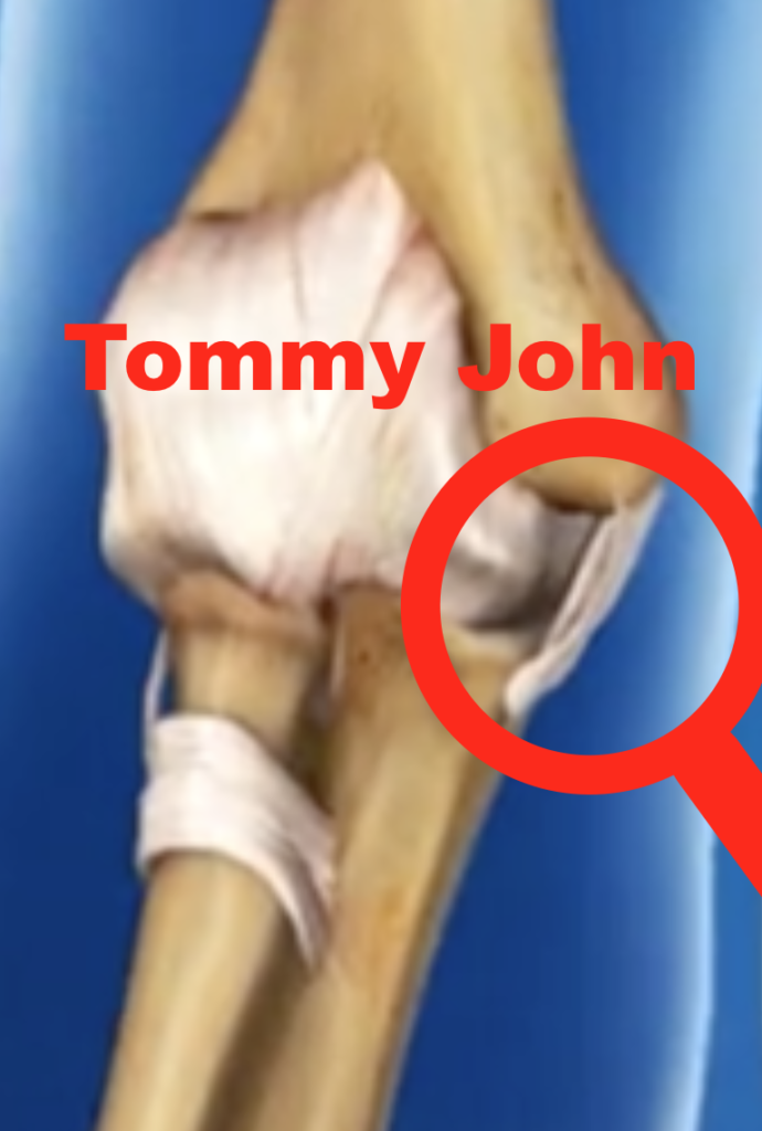 Tommy John In Baseball ShoulderSphere